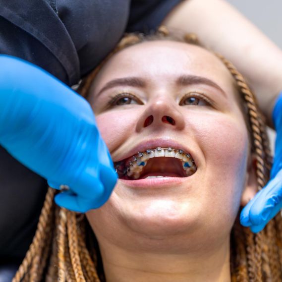 Dental braces for teeth straightening treatment